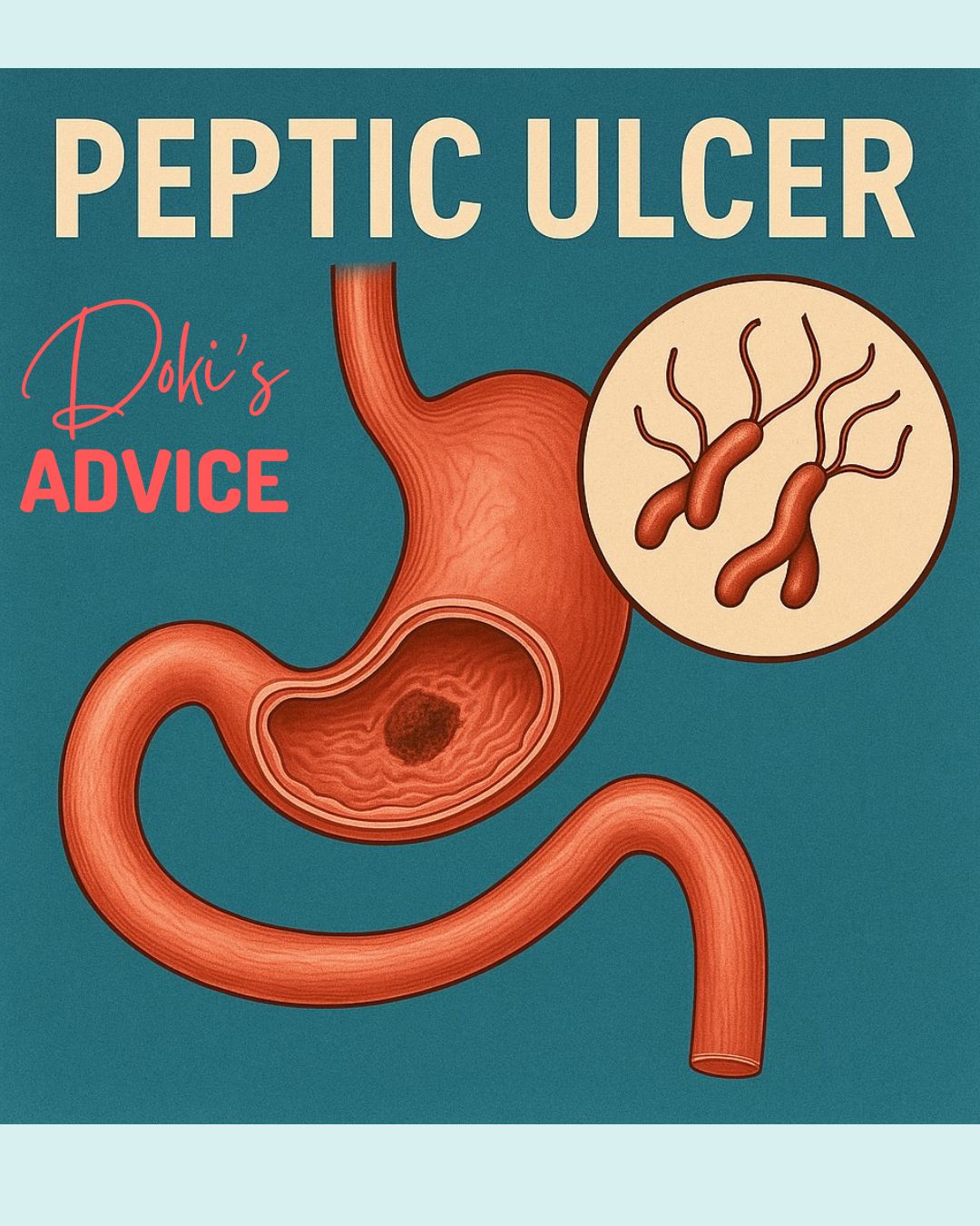 peptic-ulcer-pic.jpg